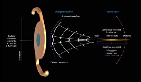 Figure 1 From The Novel Optical Design And Clinical Classification Of A Wavefront Shaping