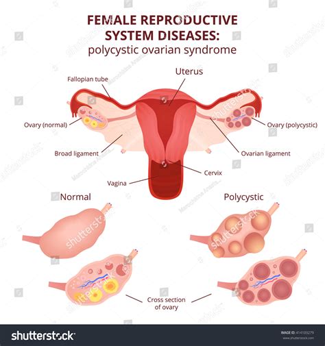 Vektor Stok Female Reproductive System Uterus Ovaries Scheme Tanpa