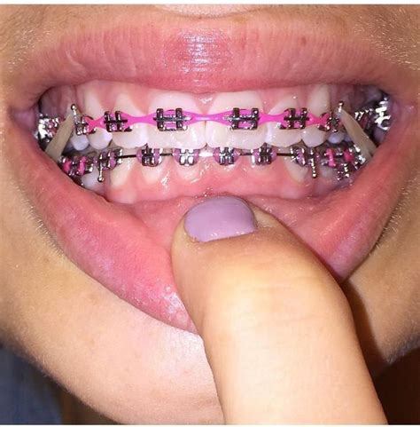 Pin By Tamia On Braces Teeth Colors Braces Colors Cute Braces Colors