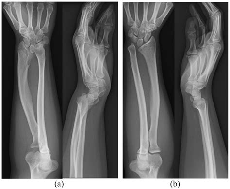 A Posteroanterior Radiography Showed Ulnar Tilting Of The Distal