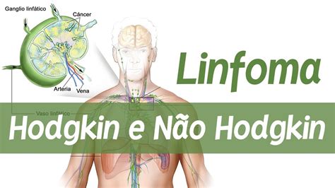 Linfoma de Hodgkin e Não Hodgkin Fisiopatologia e Patologia YouTube