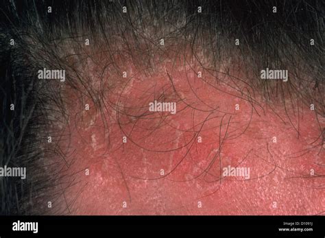 Erupción De Psoriasis Fotografías E Imágenes De Alta Resolución Alamy