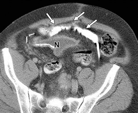 Follow The Stream Imaging Of Urinary Diversions RadioGraphics