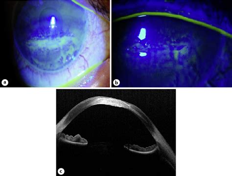 Figure 3 From Neurotrophic Keratopathy Treated With Topical Recombinant Human Nerve Growth