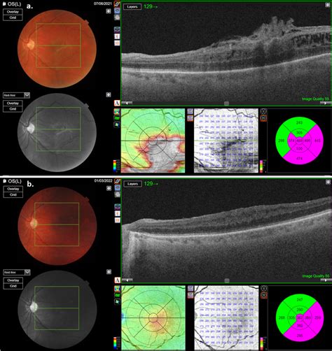 OCT scan of the second patient with macular pucker: (a) pre-operative ...