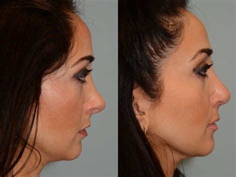 Revision Rhinoplasty In Houston