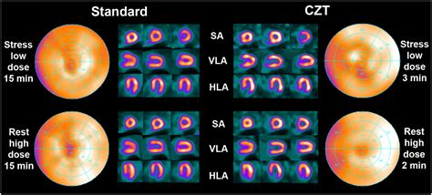 Nuclear Myocardial Perfusion Imaging With A Cadmium Zinc Telluride