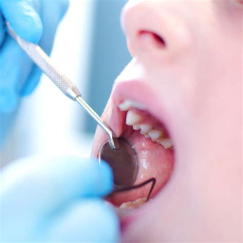 Step By Step Guide On Preventing Tooth Decay Smilewide Dental Clinic