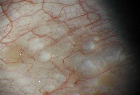 Conjunctival Lymphangiectasia: Best treatment strategies