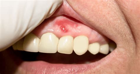 Periodontitis la grave infección en las encías que afecta más allá de