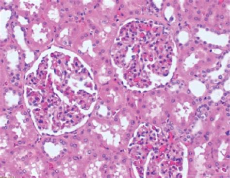 Ad The Micrograph Of A Clear Cell Renal Cell Carcinoma H E Stain