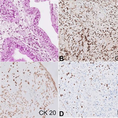 Photomicrographs Of The Colon A Signet Ring Cell Carcinoma In Colonic Download Scientific