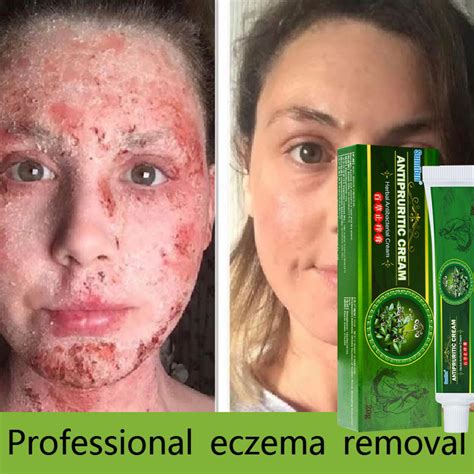 Eczema Treatment Anti Bacterial Skin Fungus Cream Psoriasis