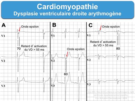 D Finitions Page Sur E Cardiogram