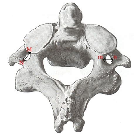 A Anterior View Of Axis Showing Superior Articular Facet External