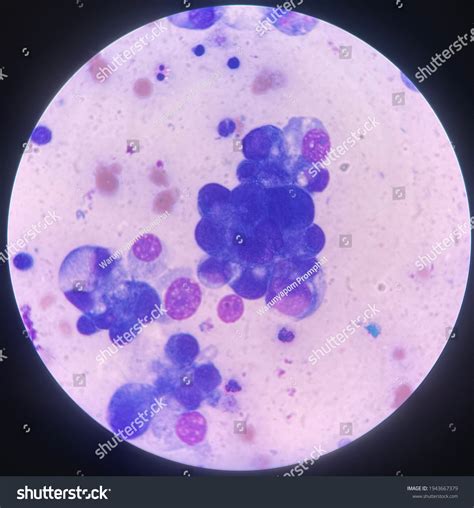 Ascitic Fluid Peritoneal Fluid Analysis Wrights Stock Illustration ...