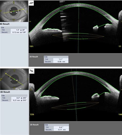 Anterior Ocular Segment Optical Coherence Tomography Findings A Slight