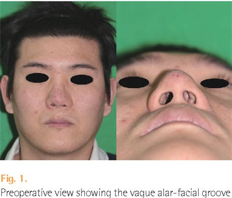 Figure 1 From Reconstruction Of The Alar Facial Groove Using A