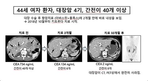 4기 대장암 100명 중 5명 완치 가능 면역항암제 키트루다