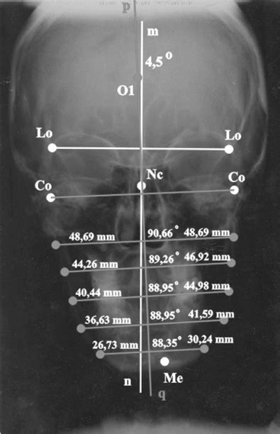 Cephalometric Graphical Evaluation Of The Exact Location Of Transverse