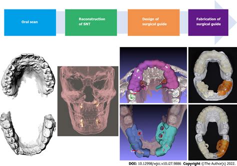 Application Of Digital Positioning Guide Plates For The Surgical