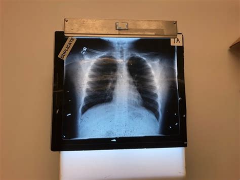 Chest X Rays Flashcards Quizlet