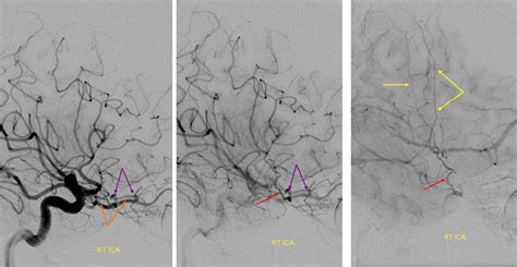 Middle Meningeal Artery | neuroangio.org