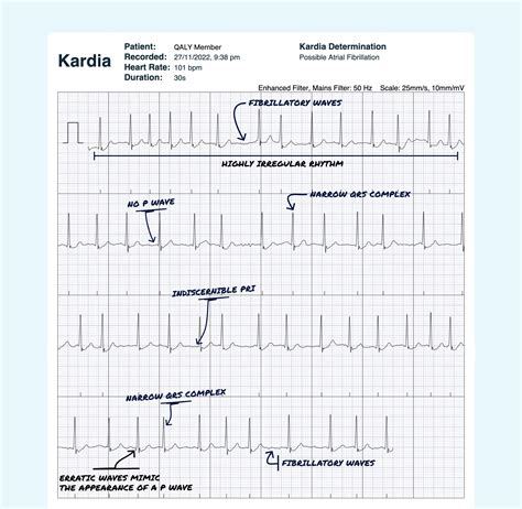 Premature Atrial Contraction Multiple Vs Atrial Fibrillation On Your