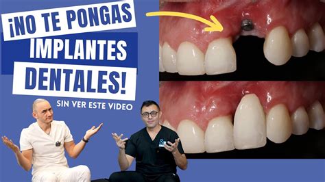 No Te Pongas Un Implante Dental Sin Ver Este Video YouTube