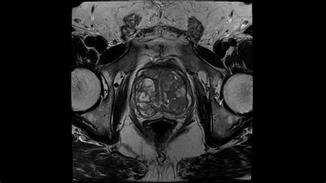 Explore Clinical Images From The Magnetom Portfolio With Deep Resolve