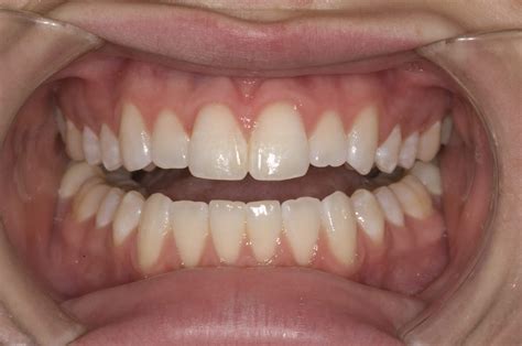 Before And After Gallery Envision Dental Dentist In Marietta Ga