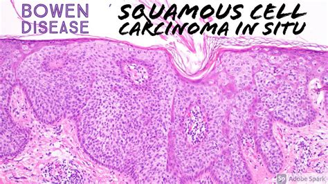 Squamous Cell Carcinoma In Situ Bowen S Disease With Clear Cell