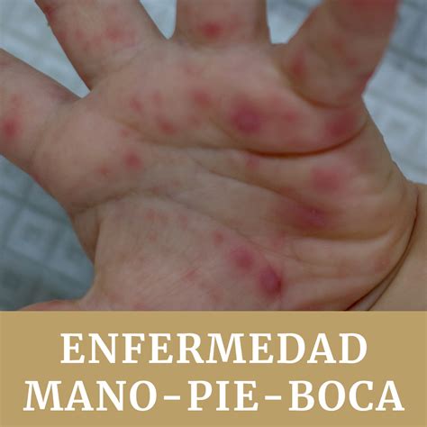 Quiero Anotar Borde Tratamiento Sindrome Boca Mano Pie Resultado