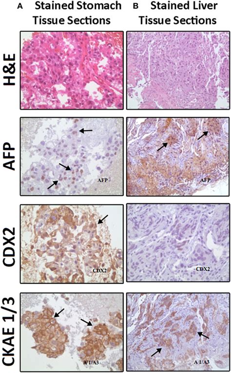 Frontiers Hepatoid Adenocarcinoma Of The Stomach A Challenging