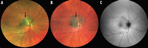 Choroidal Nevus With Lipofuscin