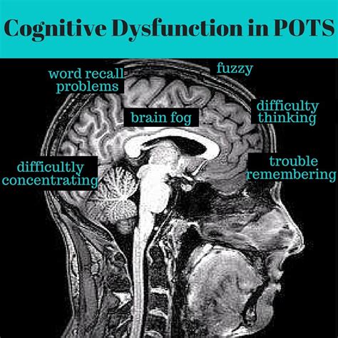 Cognitive Dysfunction And Brain Fog” In Pots The Dysautonomia