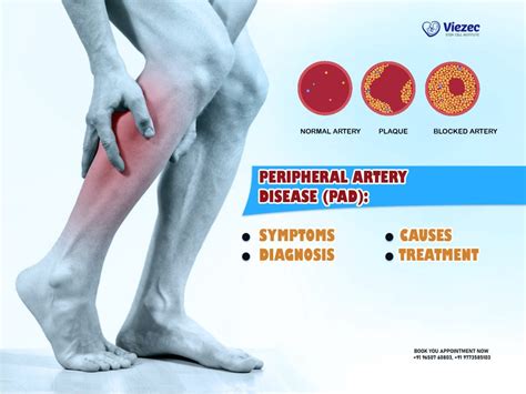 Peripheral Artery Disease Symptoms Causes Diagnosis Treatment