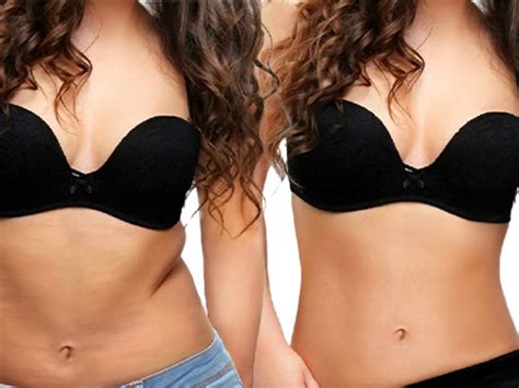 Reverse Tummy Tuck Before And After