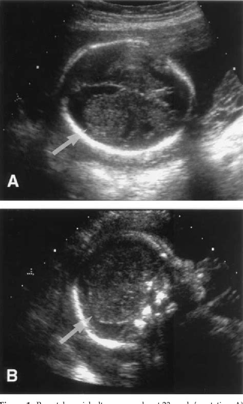 Figure From Prenatal Sonographic Findings Associated With Sporadic