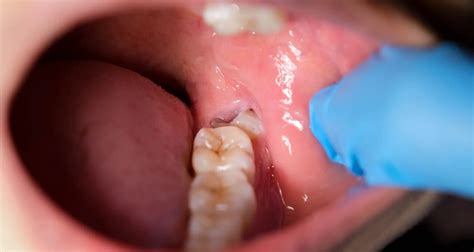 Removing Food Stuck In Wisdom Tooth Hole Effective Ways