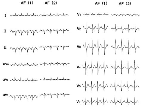 Alternation In The Flutter Wave Morphology During Radiofrequency