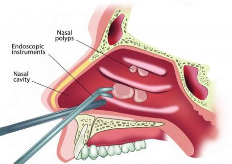 Nasal Polyps Removal