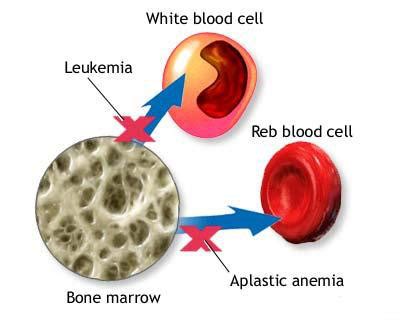 Aplastic Anemia Causes, Symptoms, Diagnosis and Treatment - Natural ...