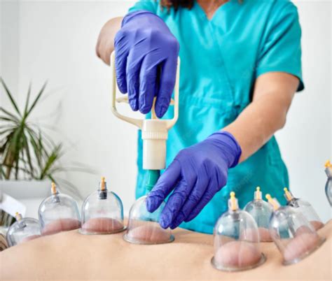 Hijama Cupping Therapie Melezza Health Care