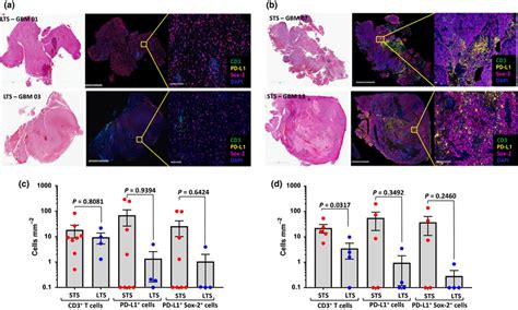 Multiplexed Immunohistochemical Analysis Of CD3 PDL1 And Sox2 In GBM