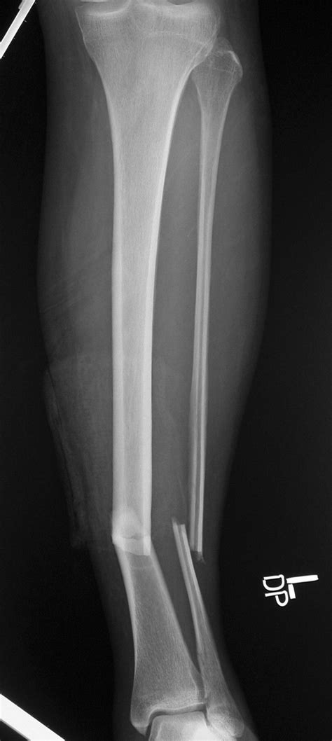 Low Adherence to Open-Fracture Antibiotic Guidelines - OrthoBuzz