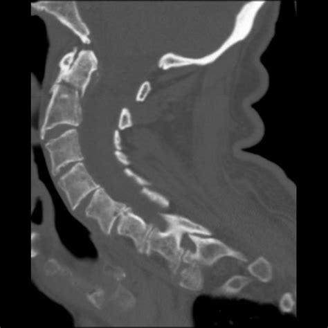 Post Gad: Dens Fracture