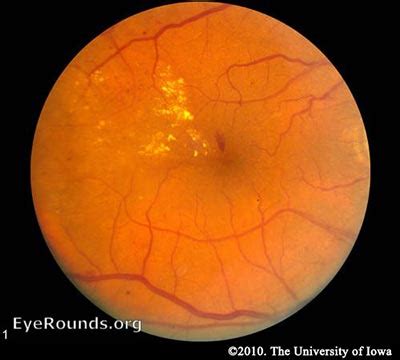 Diabetic Retinopathy for Medical Students. Classification