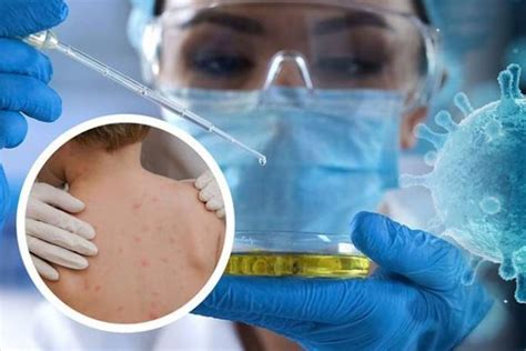 Le Maroc Enregistre Un Premier Cas De Mpox