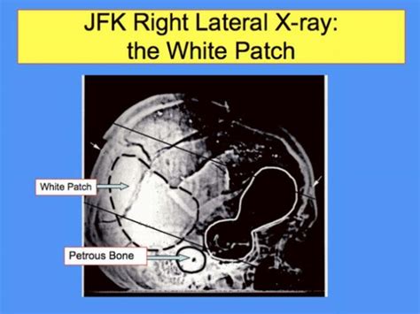 The JFK Autopsy Skull X-rays Prove The Government Knew Oswald Wasn’t a ...